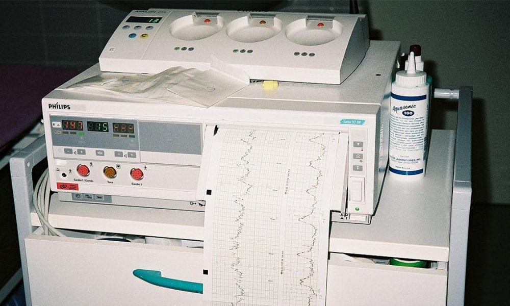 Kada treba da uradite CTG u trudnoći