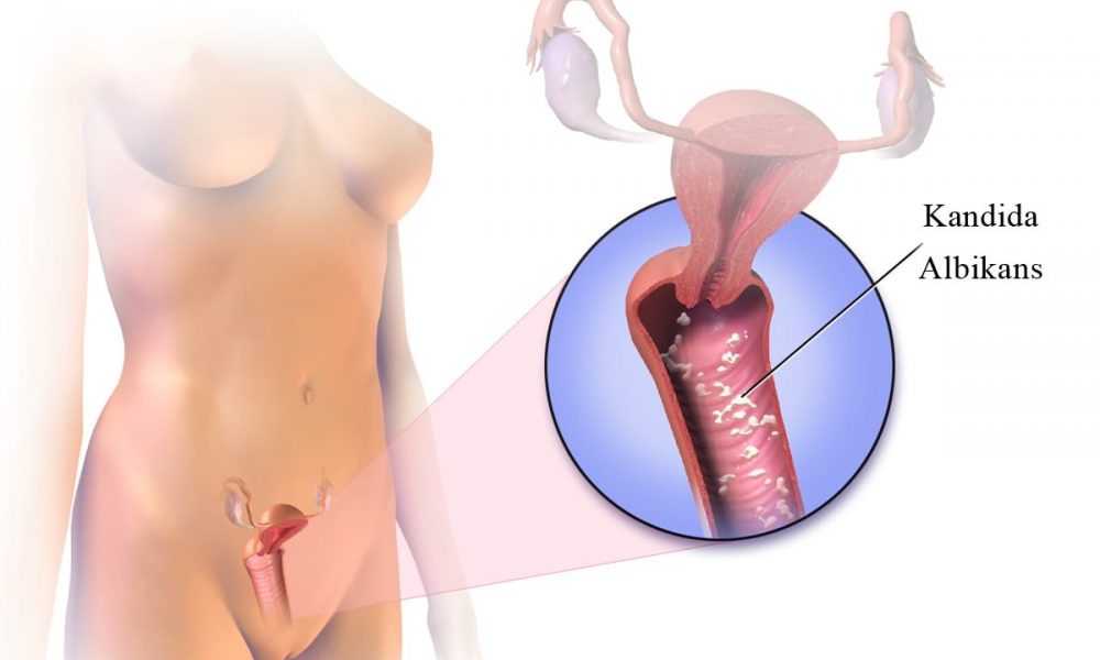 kandida-albikans-prikaz