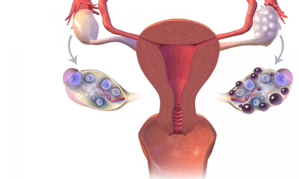 kako-prepoznati-policisticne-jajnike