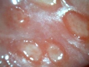 genitalni-herpes